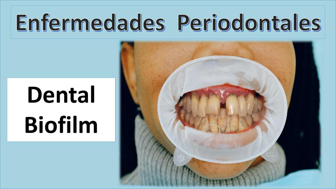 Enfermedades Periodontales: BIOFILM