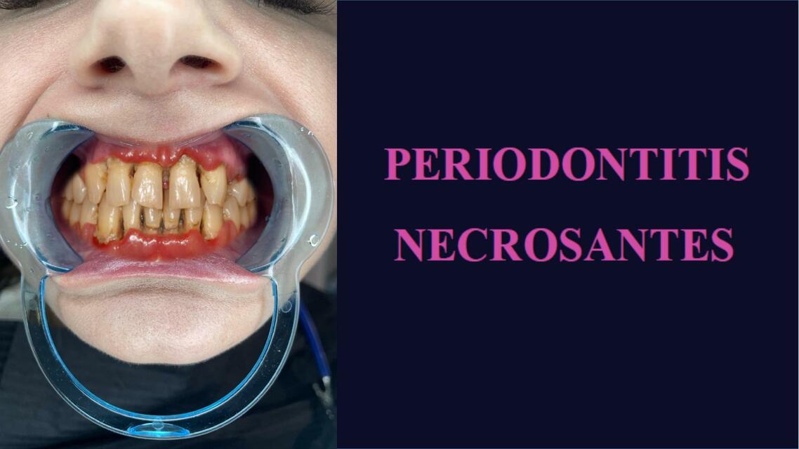 Periodontitis Necrozante