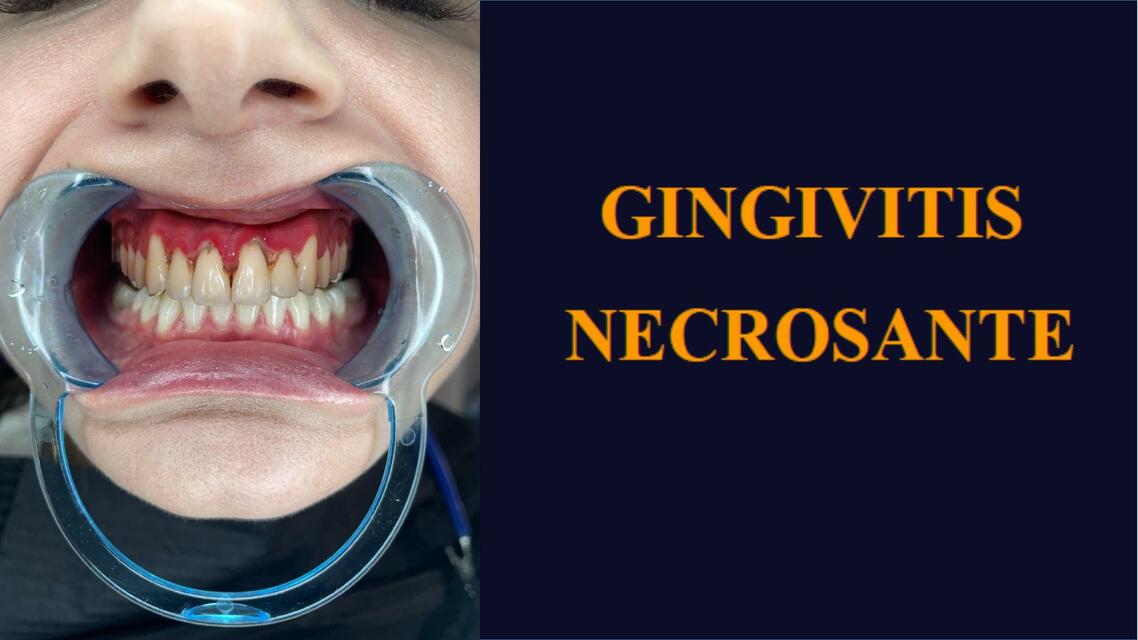 Gingivitis Necrozante