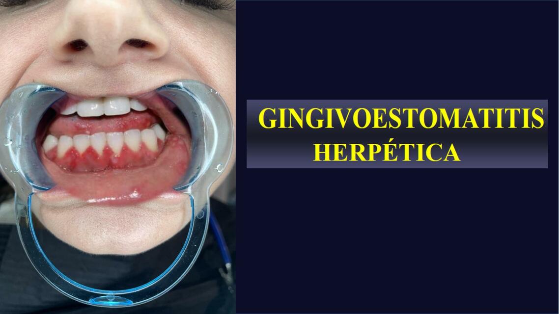 Gingivoestomatitis Herpetica