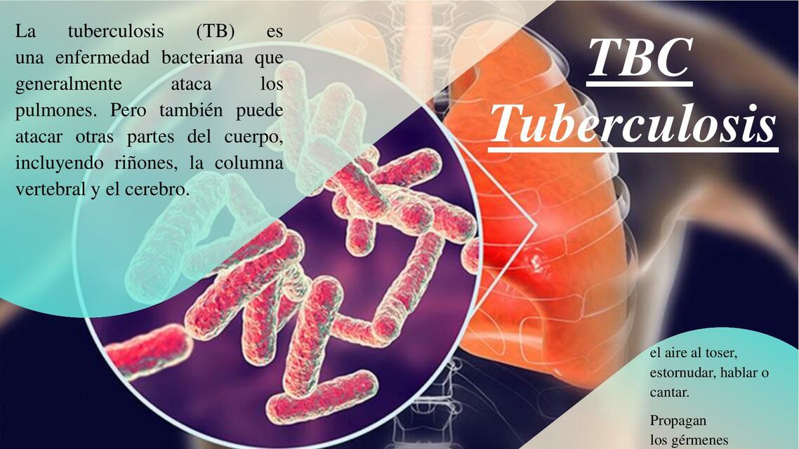 TBC Tuberculosis