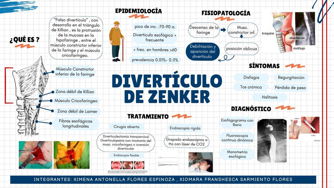 Divertículo de Zenker 