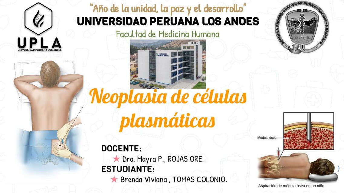 Neoplasia de células plasmáticas