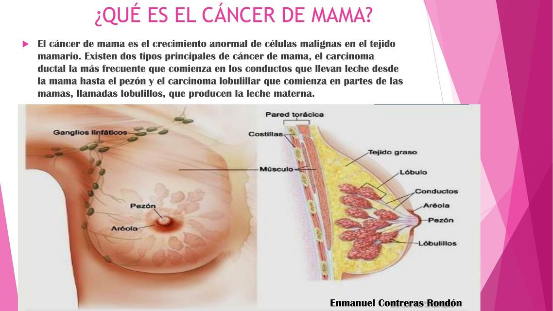 Cancer de Mama