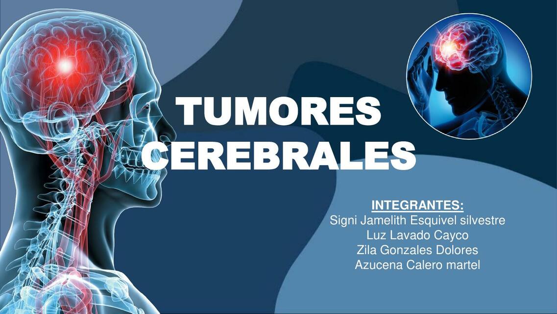 Tumores cerebrales