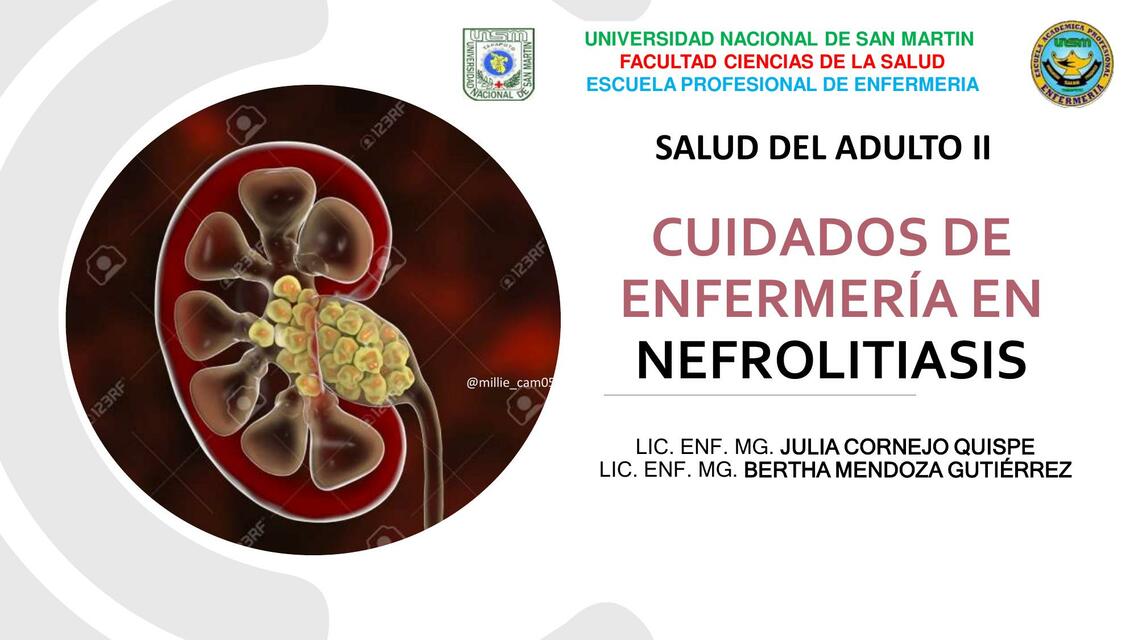 Cuidados de Enfermería en Nefrolitiasis 