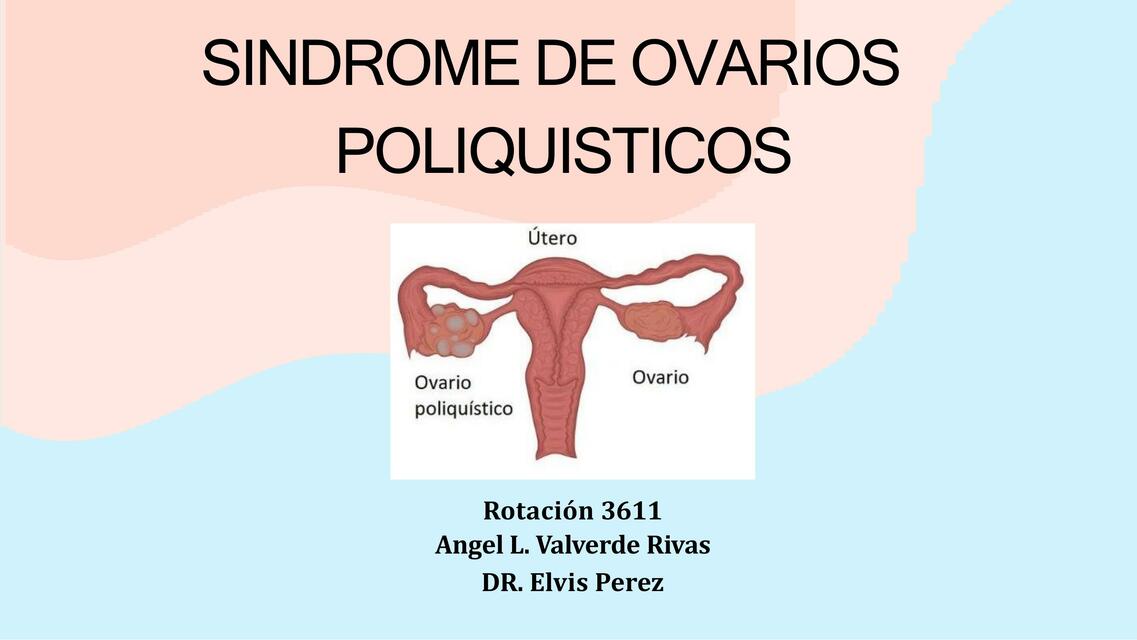 Sindrome ovarios poliquisticos