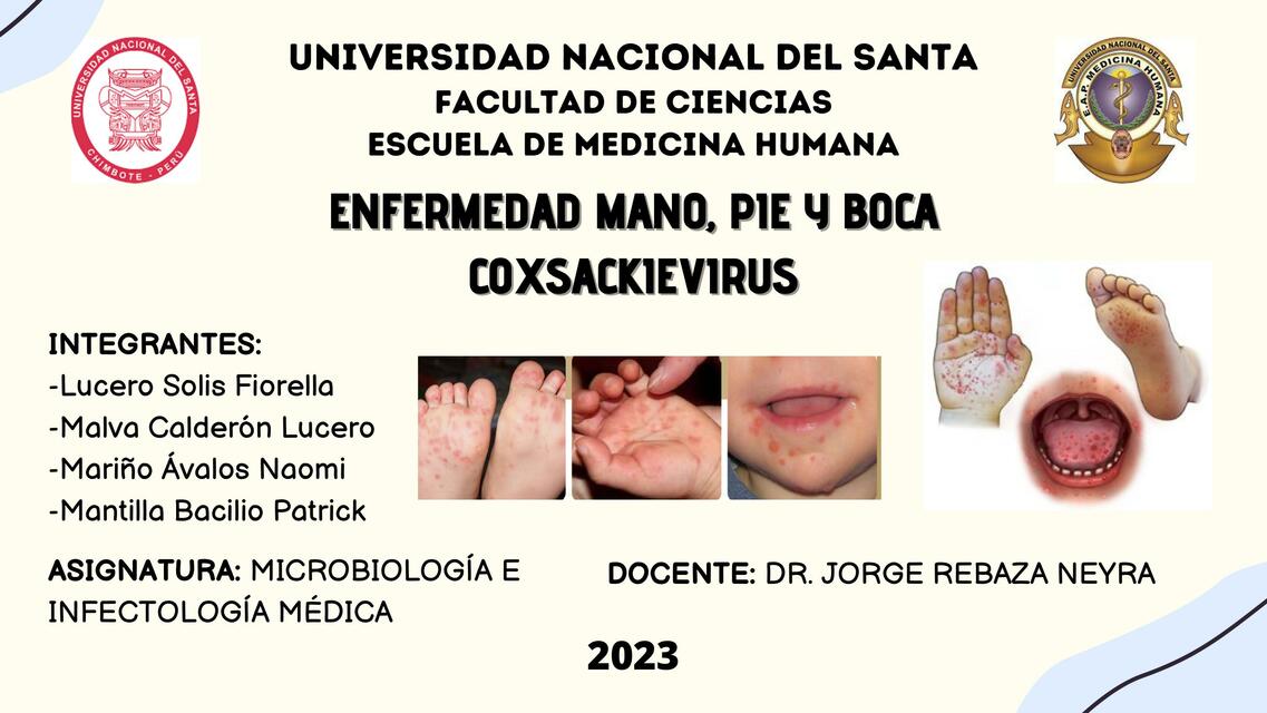 Enfermedad Mano, Pie y Boca Coxsackievirus 