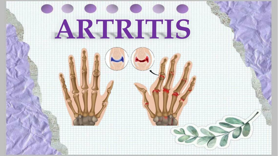 Artritis 