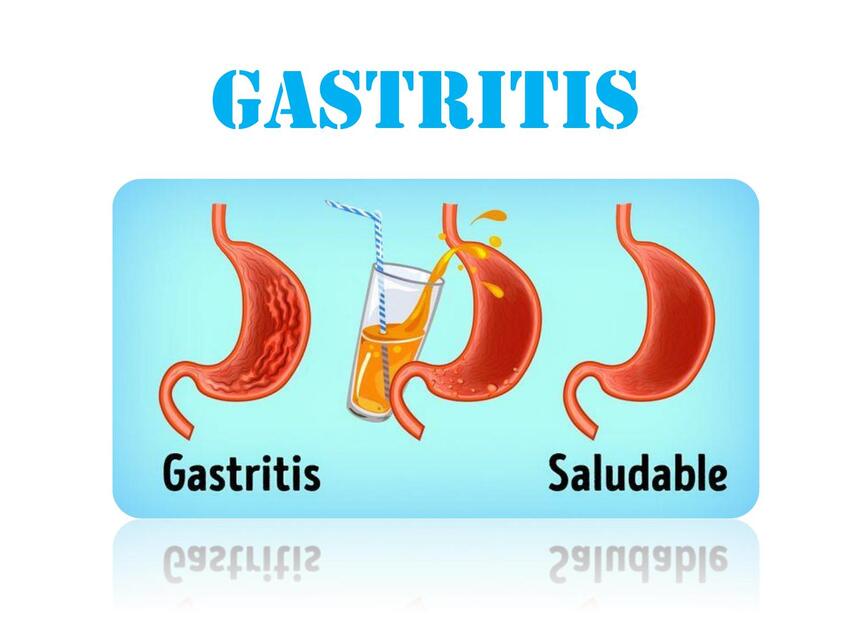 Gastritis 