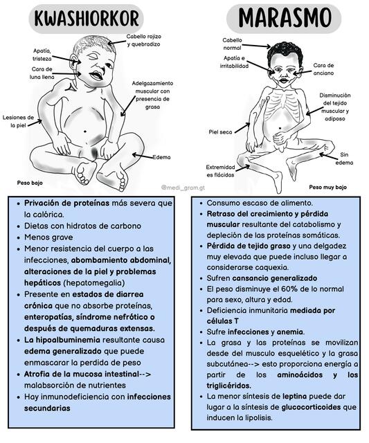 Diferencia Entre Kwashiorkor Y Marasmo Medi Fer Udocz