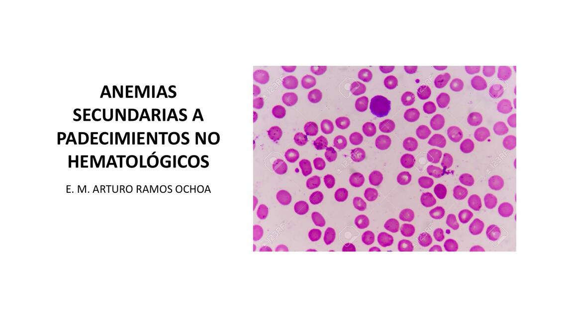 Anemias Secundarias a Padecimientos No Hematológicos