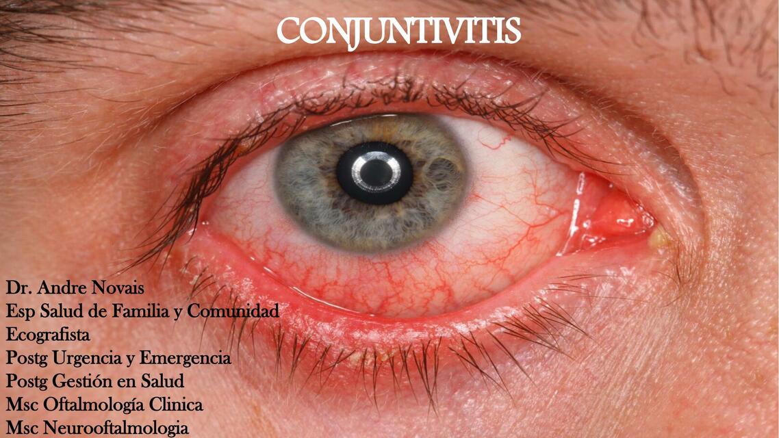 Conjuntivitis 