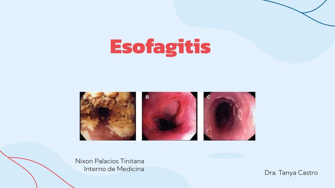 Esofagitis 