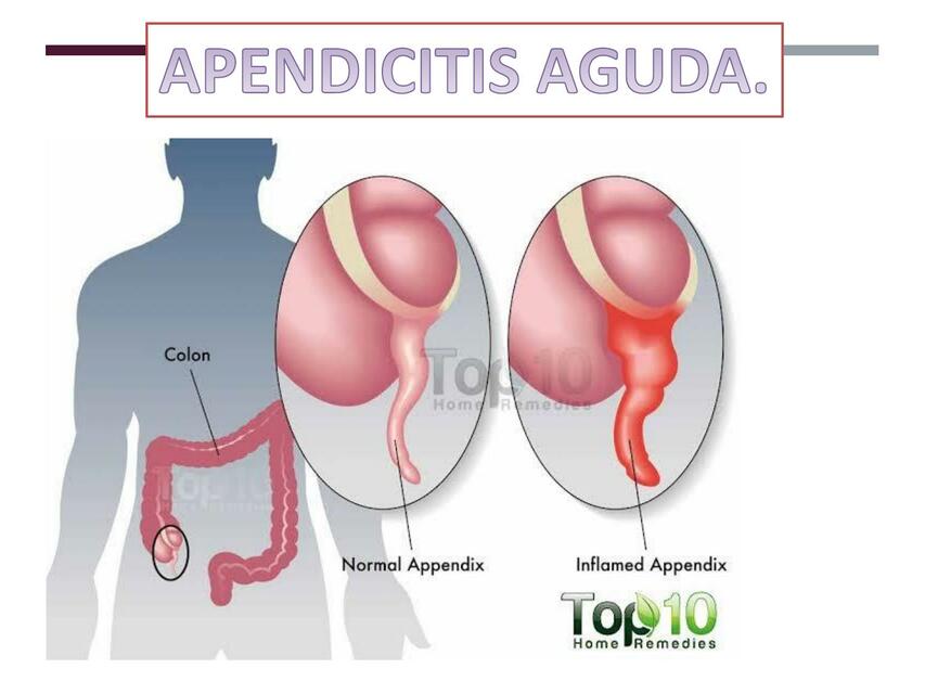 Apendicitis Aguda 