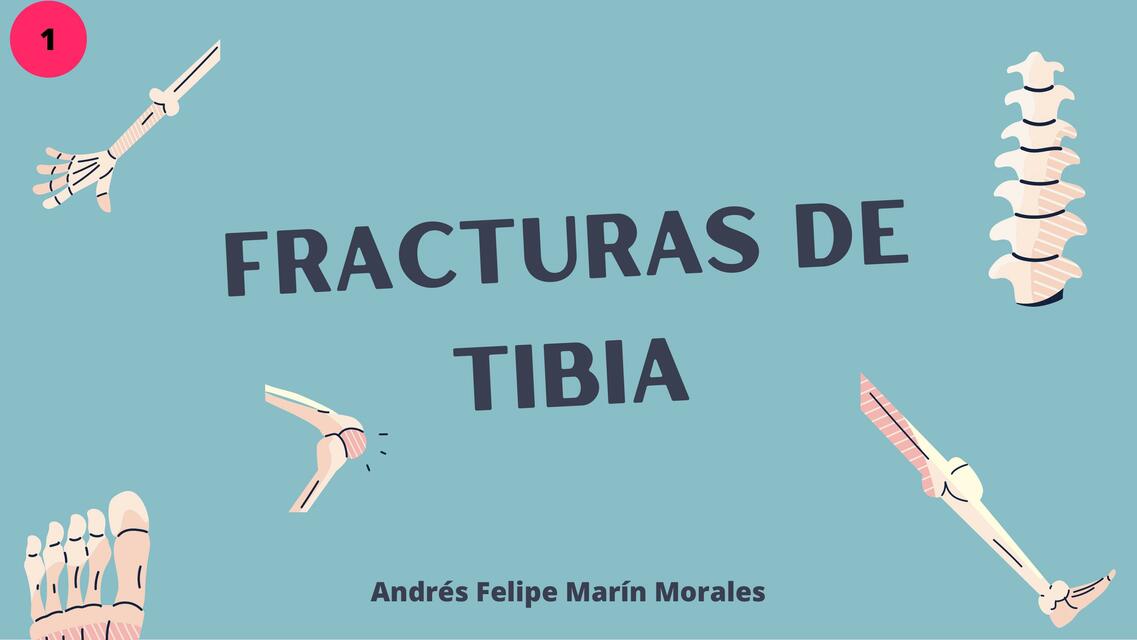 FRACTURAS DE TIBIA