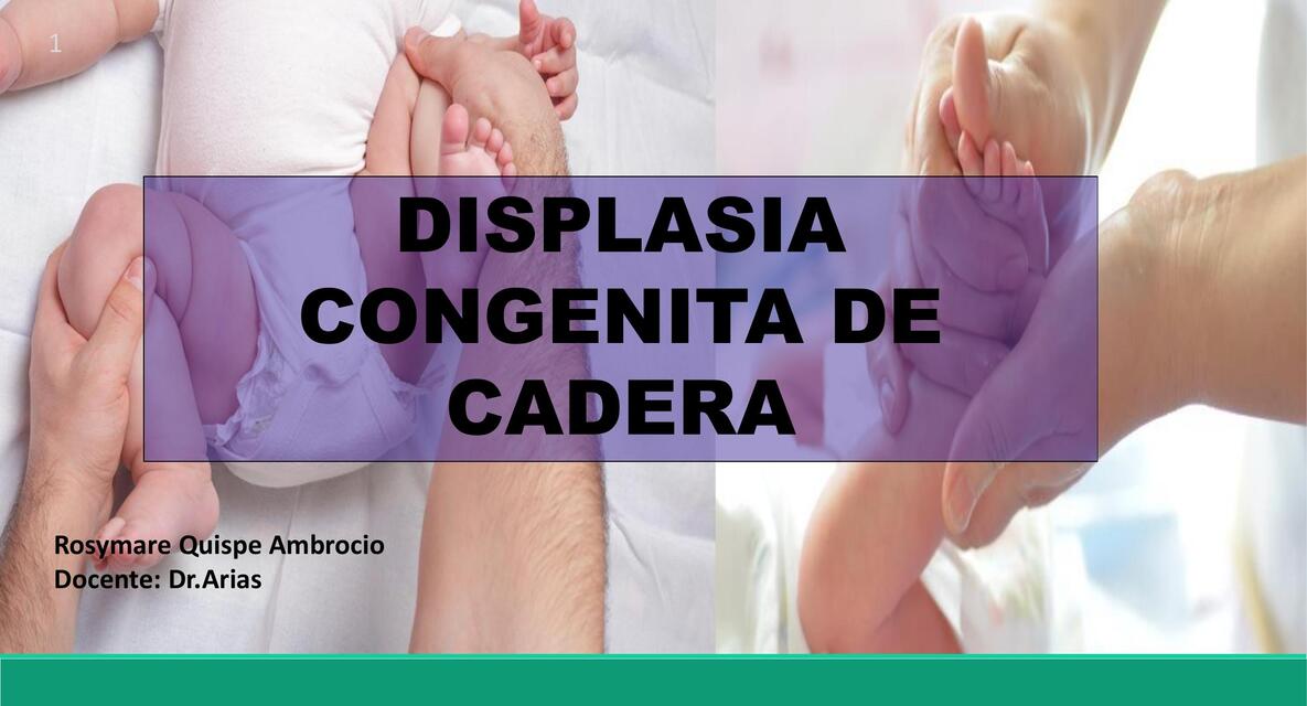 Displasia congenita de cadera 