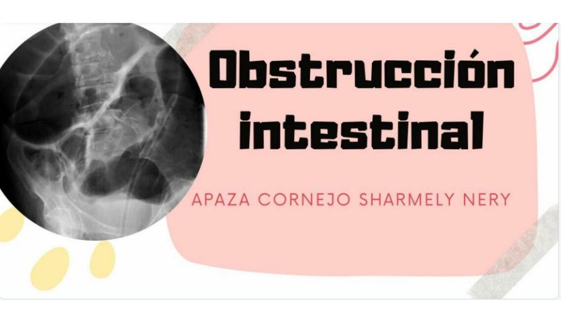 Obstrucción Intestinal 