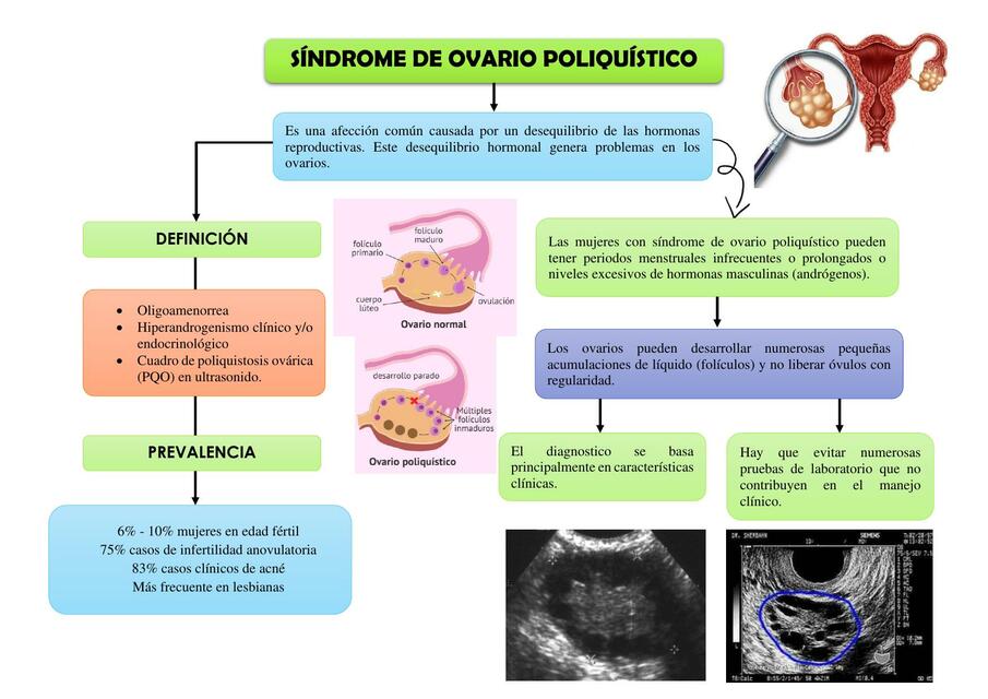 Síndrome de ovario poliquístico