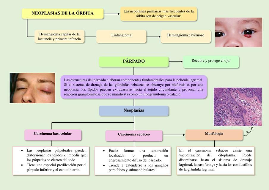 Neoplasias de la órbita