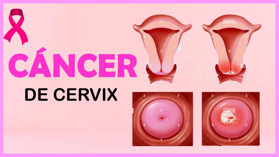 Cáncer de Cérvix   