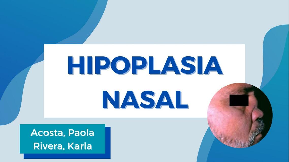 Hipoplasia nasal