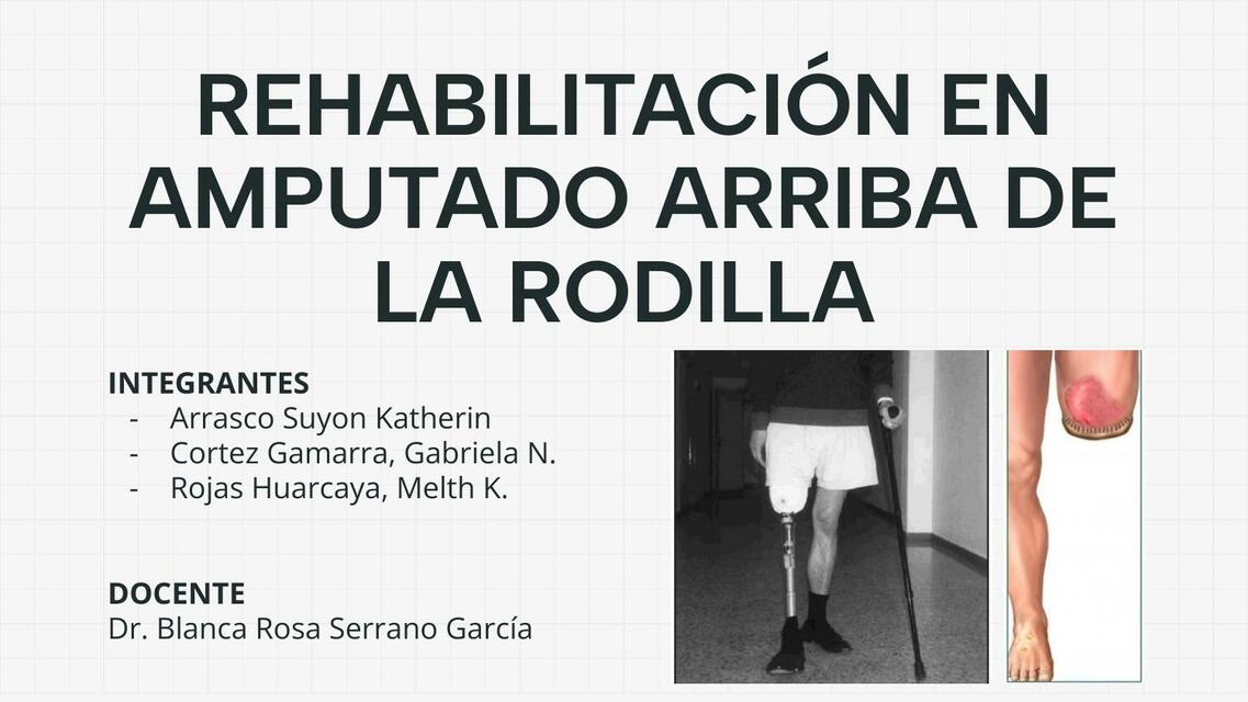 Rehabilitación en amputado arriba de la rodilla 