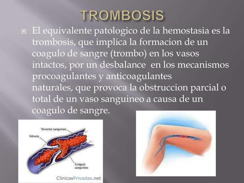 Trombosis 