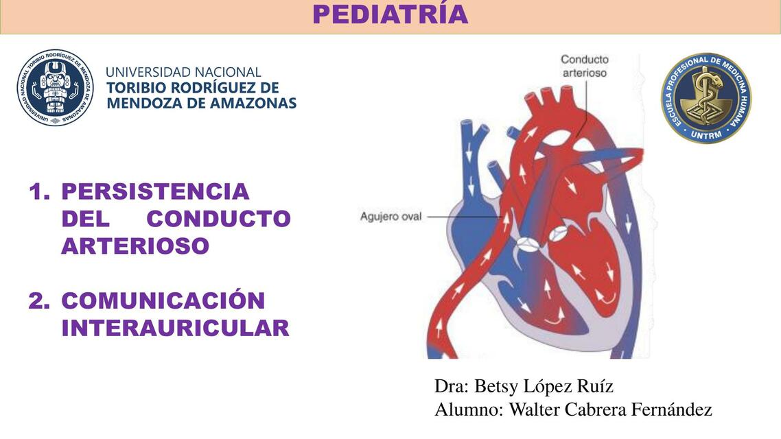 Persistencia del conducto arterioso 