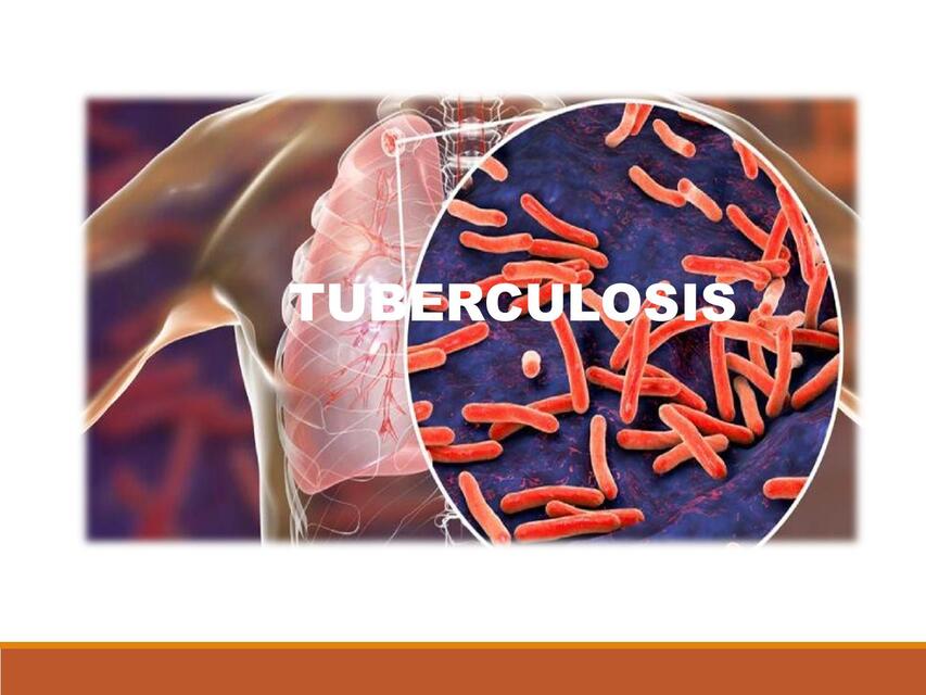 Tuberculosis 