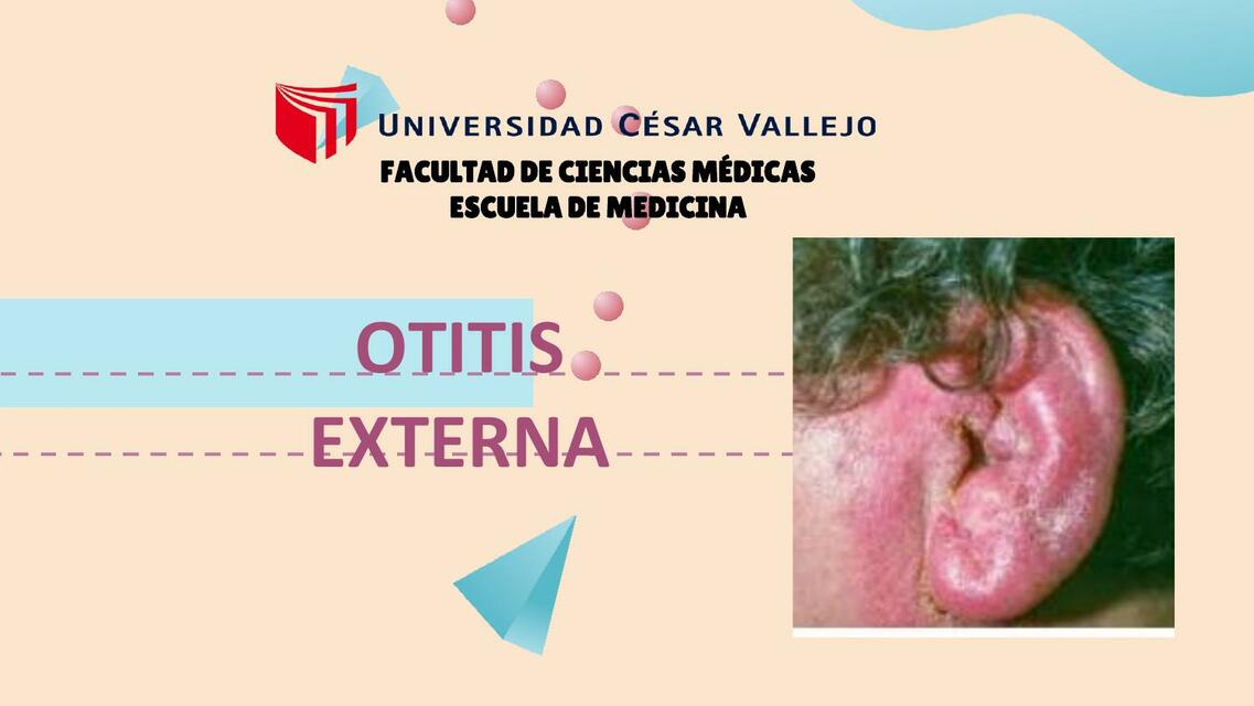 Otitis Externa