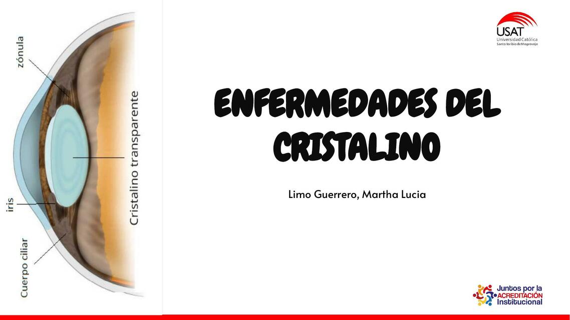 Enfermedades del cristalino 