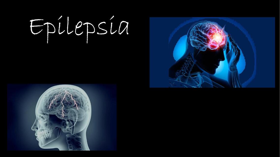 Epilepsia