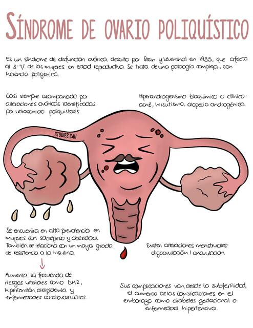 Síndrome de ovario poliquístico