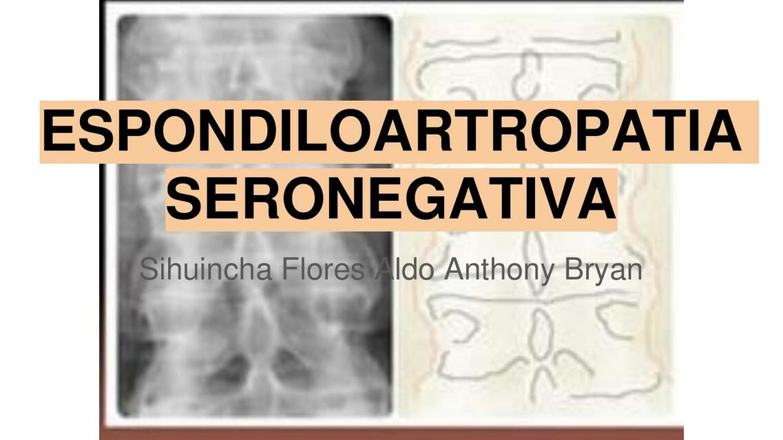 Espondiloartropatia seronegativa