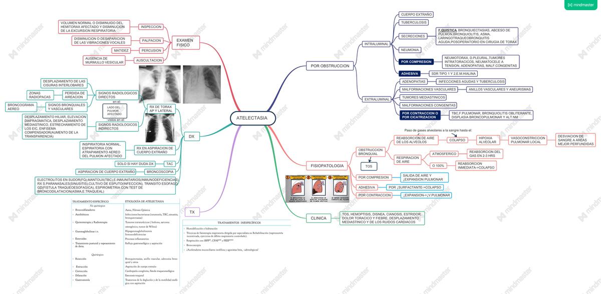 ATELECTASIA MAPA CONCEPTUAL