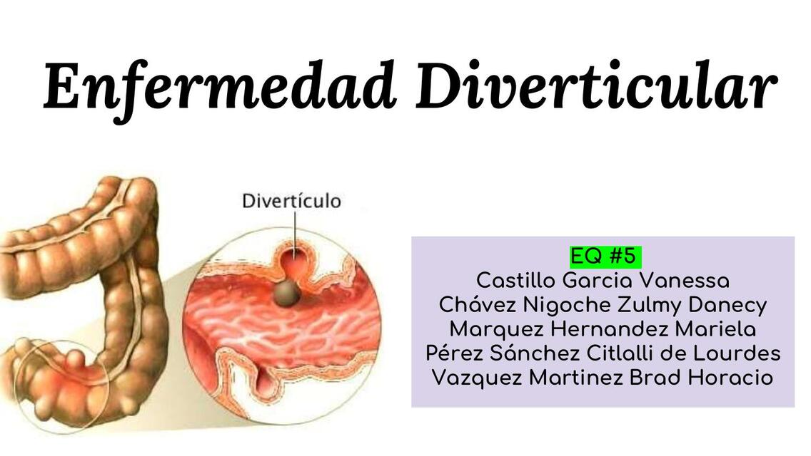 Enfermedad Diverticular