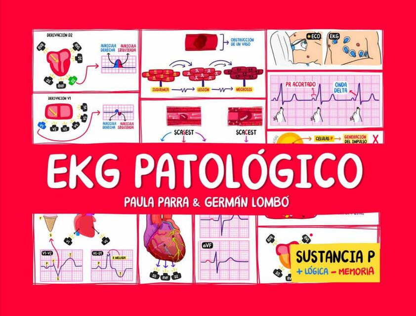 EKG patologico