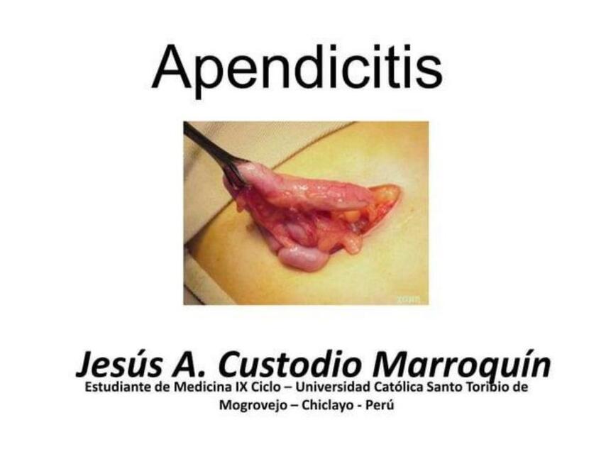 Apendicitis aguda JGS