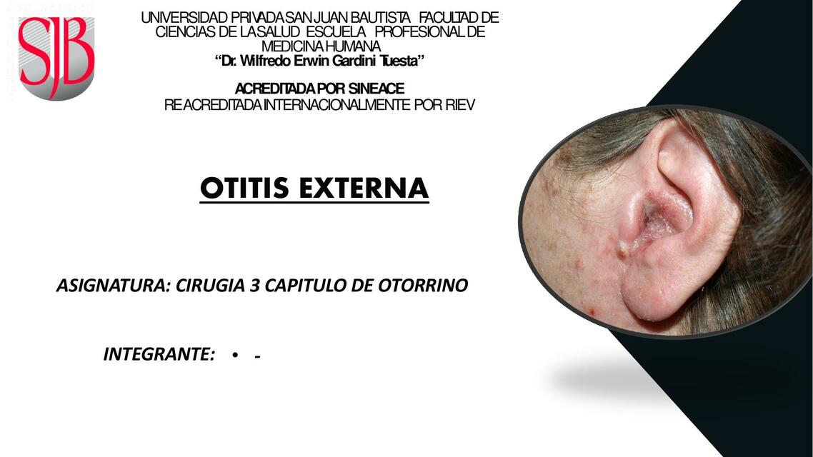 Otitis Externa 