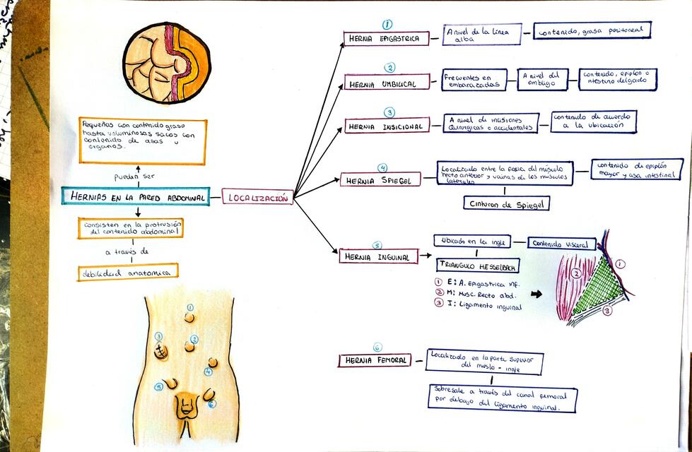 Hernia de la Pared Abdominal