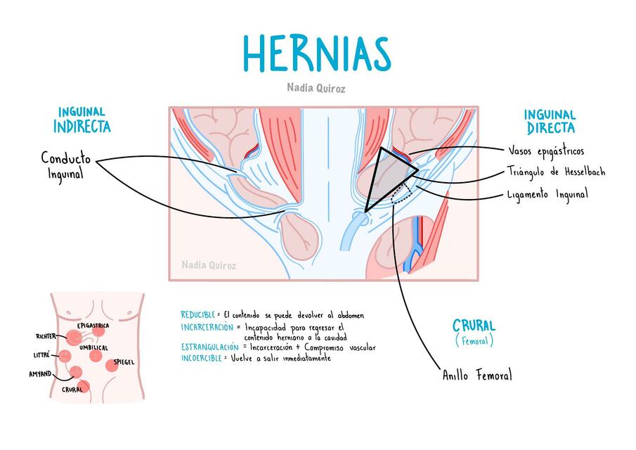 Hernias