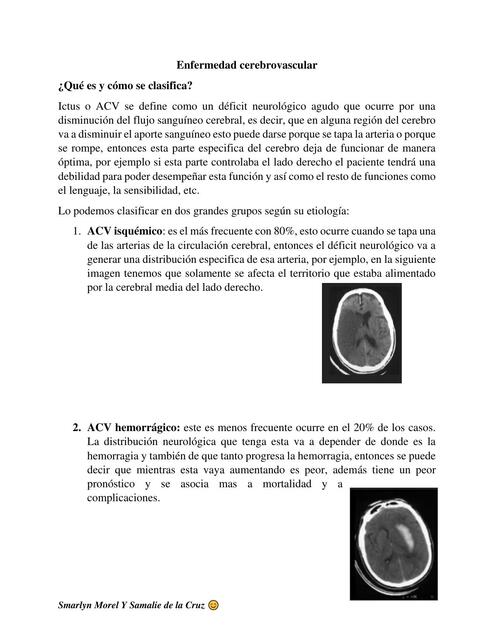 Enfermedad cerebrovascular