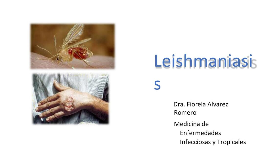 Leishmaniasis 