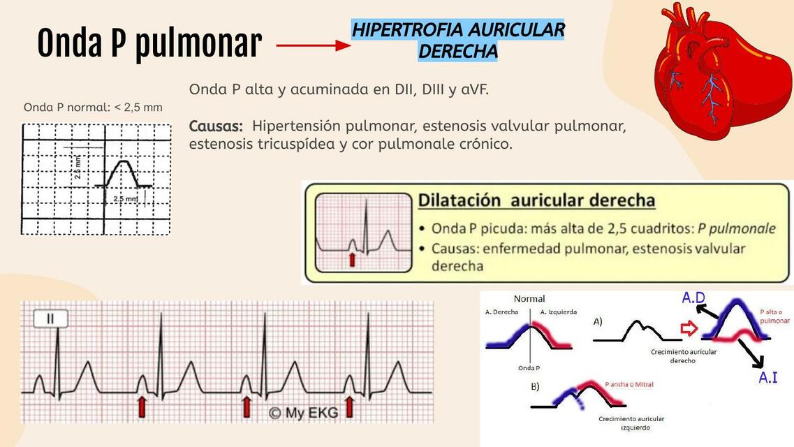 Onda P Pulmonar