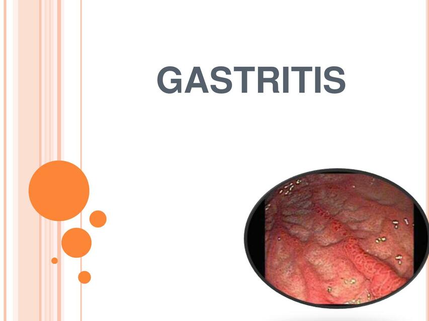 3 Gastritis