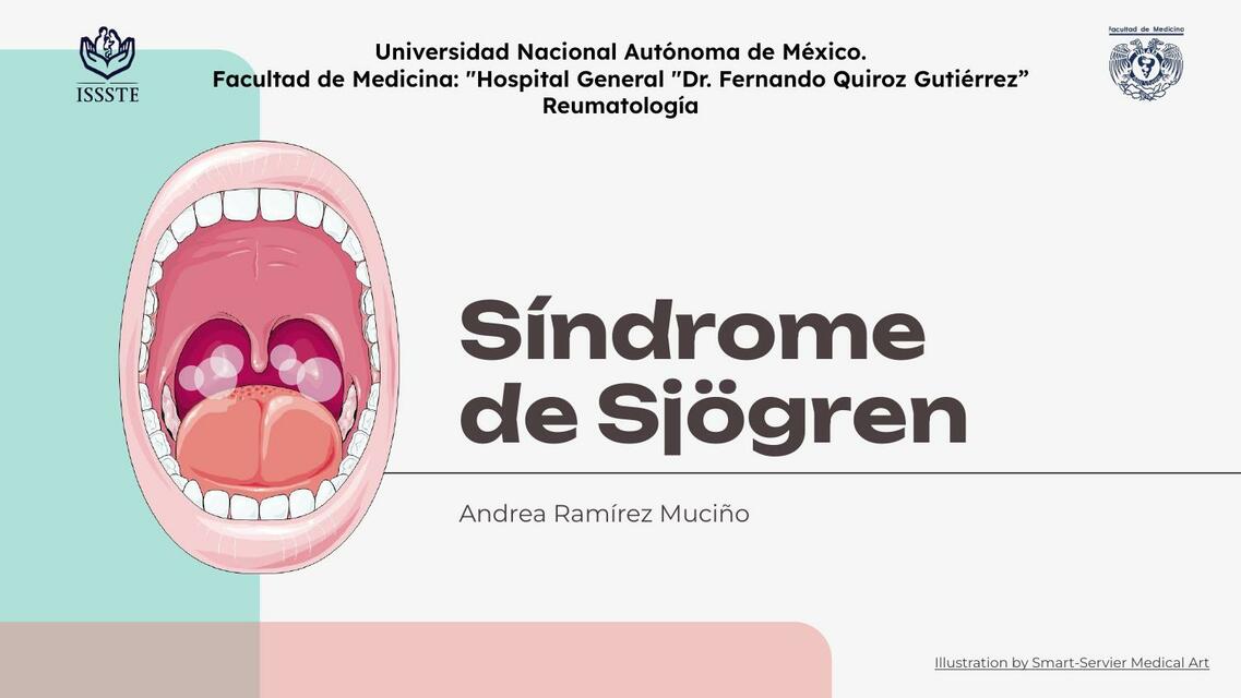 Síndrome de Sjögren 