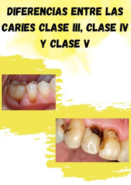 Diferencias entre las caries clase III, clase IV y clase V