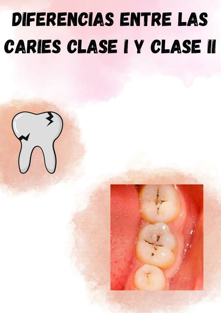 Diferencias entre clase I y clase II