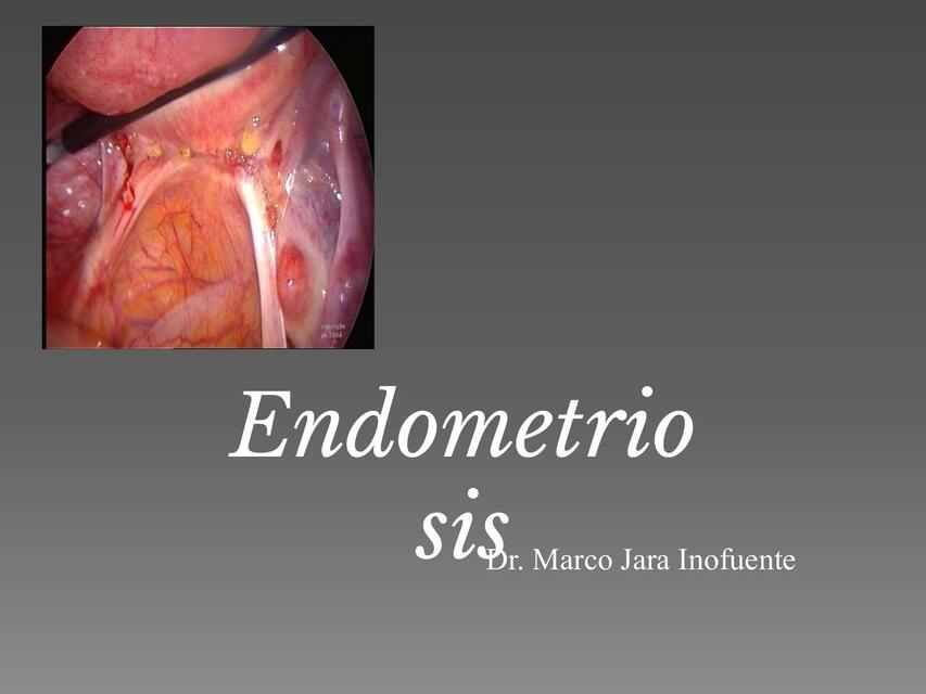 Endometrio